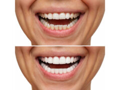 Denti, faccette dentali