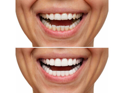 Denti, faccette dentali